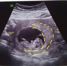 an x - ray shows the right side of a breast with yellow arrows in it