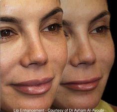 Lip Enhancement, Aesthetic Clinic, Before After Photo, Best Advice, Dermal Fillers, Lip Fillers, Beautiful Lips, After Photos, Good Advice