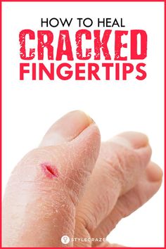 Cracked Fingertips, Dry Hands Remedy, Warts On Face, Cracked Hands