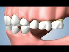 Dental Videos Education For Patients, Teeth Whitening Procedure, Implant Dentist, Tooth Filling, Dental Implants Cost, Partial Dentures