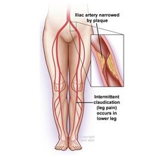 Peripheral Arterial Occlusive Disease, Crna School, Health Women, Vascular Surgery, Improve Nutrition, Stem Cell Therapy, Medical Anatomy, Wound Care