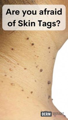 If you’re looking for products to get rid of skin tags, we’ve got you covered with a list of some of the best skin tag remover products of 2024. Clear Flawless Skin, Home Remedy For Cough, Cold Home Remedies