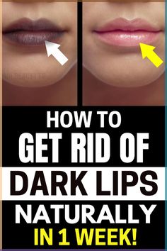 Lips of varying shades and colors are a natural occurrence, but hyper-pigmentation may cause cosmetic and health problems. Instead of using chemical treatments or pharmaceuticals, most people find that using natural and organic remedies is all that's needed to get rid of this discoloration for good. If your lips have become too dark, continue reading to discover how to naturally lighten them. Here are 4 Natural Remedies to Lighten Dark Lips at home!#beautytips#darklips#lipsremedy Pigmentation Remedy, Remedies For Dark Lips, Lighten Dark Lips, Remedies For Dry Mouth, Lip Lightening, Dark Armpits, White Lips, Dark Underarms, Pigmented Lips