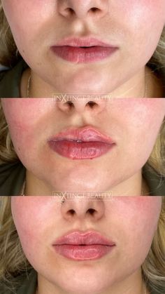 Russian Lip Technique - Lip Augmentation, Lip Filler NYC Russian Lips Technique, Lip Filler With Cupids Bow, Filler Migration Lips, .5ml Vs 1ml Lip Filler, Lip Filler Cupids Bow, Russian Doll Lip Filler, Lip Augmentation Before And After, Russian Lips Filler 1ml, Lip Filler Journey