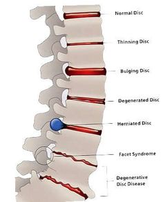 Bolesti Chrbta, Bulging Disc, Surgical Nursing, Medical Surgical Nursing, Medical Student Study, Human Body Anatomy, Spine Health, Medical School Studying, Human Anatomy And Physiology