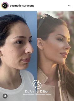 #plasticsurgery #plasticsurgerygonewrong #beforeafter #celebritiesbeforeafter #hollywoodstars #bignosesurgery #surgery #facesurgery #vlinesurgery #koreanplasticsurgery #kpopplasticsurgery #nosejob #jawreductionsurgery #eyesurgery #cheekfillers #rhinoplasty #facelift #plasticsurgeryfails #expensiveplasticsurgery Makeup Skin Tone, Before And After Makeup Transformation, Nose Surgery Rhinoplasty, Cheek Implants, Face Transformation, Plastic Surgery Fail, Chin Augmentation, Chin Implant