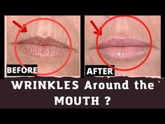 Wrinkles Around Mouth, Upper Lip Wrinkles, Rid Wrinkles, Face Wrinkles Remedies, Herbs Medicine, Wrinkles Remedies, Wrinkles Remedies Face, Smokers Lines, Mouth Wrinkles