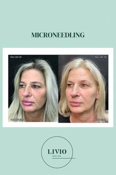 Microneedling is a fantastic way to rejuvenate your skin and make you glow.It can treat lines and wrinkles, poor skin tone or texture , and scars on both face and body. Skinpen Microneedling, Covington Ky, Health Vitamins, Cold Home Remedies, Lose 40 Pounds, Lost Weight, Natural Health, Skin Tone