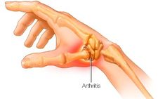 What is Thumb Arthritis? CMC joint arthritis also known as thumb arthritis occurs at the base of your thumb, where your thumb and wrist meet. Named for the bones that make up the base of your thumb – a Carpal (wrist) bone and a Metacarpal or long bone of the thumb – the (CMC) joint is the most common place in Hand Therapy, Home Health Remedies, Joints Pain Relief