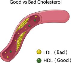 What Causes High Cholesterol, Cholesterol Test, Cholesterol Medications, Heart Healthy Diet, Lower Your Cholesterol, Healthy Cholesterol Levels, Childhood Obesity, Ldl Cholesterol