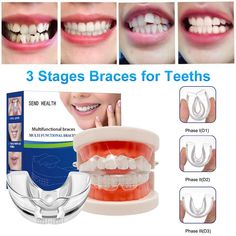 Item Description： Features: High-quality materials: dental braces are made of food-grade TPE materials, non-toxic, tasteless, soft and elastic, suitable for mandibular protrusion, deep tooth coverage, interdental space, deep coverage, irregular teeth arrangement, crowded teeth, etc. Condition. 4D invisible correction: The orthodontic appliance uses 4D invisible effect in the oral cavity, which is not only comfortable to wear, but also beautifies the teeth, improves the molars, discharges muscle Top Braces Only Teeth, Expanders For Teeth, Tooth Braces, Braces Expander, Byte Aligners, Teeth Correction, Retainer Teeth, Clean Invisalign Retainer, Tooth Repair