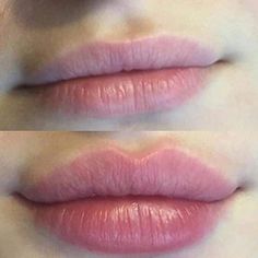 Needleless Lip Filler, Korean Lip Filler Before And After, Lip Filler Shape Ideas Pouty, Desired Lips, Dermal Fillers Lips, Juvederm Lips