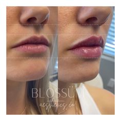 Light Lip Filler Before And After, Mini Lip Filler Before And After, Lip Filler On Full Lips, Lips Before And After, Small Lip Filler, Lipfiller Before After, Natural Lip Fillers Before And After, Lip Filler On Small Lips, Lip Filler Inspo Heart Shape