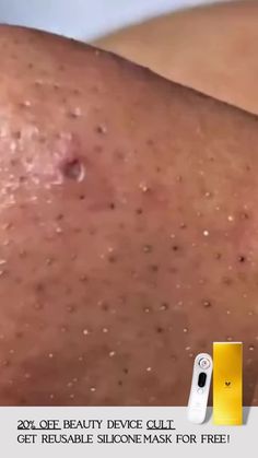 Blackheads, Health Tips, Beauty Tips, Skin Care, Skin, Health, Beauty