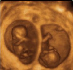 an image of two baby's in the stomach