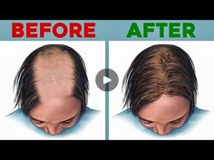 The Top 3 Foods for Hair Loss - Dr. Berg - Dr. Eric Berg DC | The Top 3 Foods for Hair Loss - Dr. Berg - Dr. Eric Berg DC
Join group:👇👇👇
https://www.facebook.com/groups/929996162034238 | By Dr. Eric Berg DC | Today, we're going to talk
about exactly what food you should be eating to help regrow
your hair and this is not about taking another supplement. This
is talking about your foods. There's something I stumbled on
recently that's actually very interesting. I'm going to share
with you is from this paper that I I read that had
something in it that just jumped out at me that I've
never heard before and then I did a deep dive into this one
single amino acid and I found some amazing things, okay? So,
I'm going to share that with you today. So, I think most
people know that hair is made ou Foods For Hair, Eat Enough, Hair Food, Amino Acid, Amino Acids, For Hair