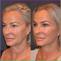 Dr. Ambe || NB Plastic Surgery on Instagram: “Here it is, the full face before and after showing not just her eyes like we did most recently but her full #facelift and #necklift before…” Mid Face Lift, Face Plastic Surgery, Neck Lift Surgery, Lipo Before And After, Facelift Before And After, Skin Improvement, Filler Pics