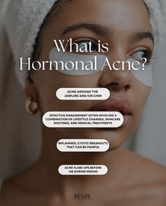 Understanding Hormonal Acne: What You Need to Know 🌿✨ Caused by Hormonal Fluctuations: Hormonal acne is triggered by fluctuations in hormone levels, especially androgens like testosterone. This can happen during puberty, menstrual cycles, pregnancy, and menopause. 🔄 Common Locations: Typically appears on the lower part of the face, including the jawline, chin, and lower cheeks, which are more sensitive to hormonal changes. 🪞 Characteristics: Often shows up as deep, cystic bumps that are pa... Painful Acne, Chin Acne, Esthetician Marketing, Skin Tonic, Skin Aesthetics, Skincare Quotes, Jewel Wedding