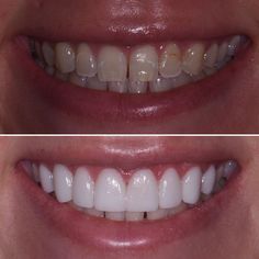 Veneer Teeth, Dentist Room, Perfect Teeth Smile, Loose Teeth, Cosmetic Dentistry Veneers, Cosmetic Dentistry Procedures, Pretty Teeth