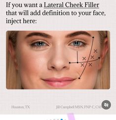 Natural Cheek Filler, Medspa Office, Cheek Injections, Botox Migraine, Face Plastic Surgery, Facial Injections, Skin Anatomy, Aesthetic Nurse