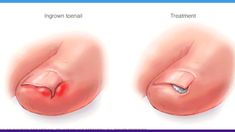 Learn about causes, prevention and treatment of this common, painful nail condition that usually affects the big toe. Ingrown Toenail, Ingrown Nail, Homemade Laundry, Ingrown Toe Nail, Toenail Fungus