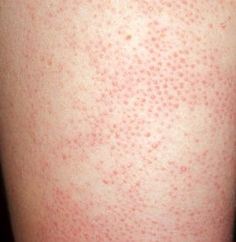 How to Get Rid of Bumps on Arms Skin Bumps On Arms, Bumps On Legs, Bumps On Arms, Keratosis Pilaris Remedy, Patchy Skin, Nail Problems, Skin Bumps, Skin Care Guide, Keratosis Pilaris