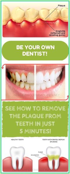 Health Tips For Women, Tooth Decay, Healthy Teeth, Health Advice, Oral Hygiene, Natural Medicine, Oral Health