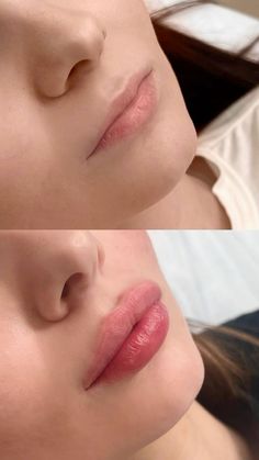 Lip Filler 1 Ml, Top Lip Filler, 1 Ml Lip Filler, Round Lips, 1ml Lip Filler, Juvederm Lips, Lips Fillers, Lip Flip, Plumper Lips