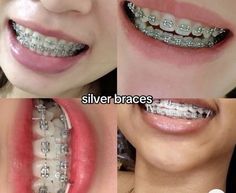 Dental Braces Colors, Braces Food, Darker Skin Tones