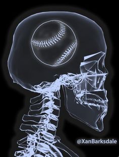 an x - ray image of a baseball in the head