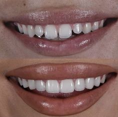 Teeth Correction, Perfect Skin Routine, Fix Teeth, Dental Posts