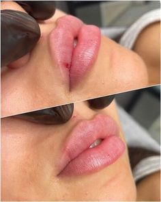 Lip Filler Sydney Lip Filler Pouty Lips, Lip Filler Types, Lip Filler For Uneven Lips, Different Styles Of Lip Filler, Sarah Cameron Lip Filler, Filler Ideas, Lip Filler Heavy Upper Lip, Defined Cupids Bow Lip Filler, Madeline Cline Lip Filler