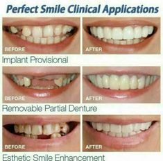 Perfect Smile Teeth, Dental Dentures, Snap On Smile, Teeth Covers, Temporary Tooth, Veneers Teeth, False Teeth, Fake Teeth, Dental Braces