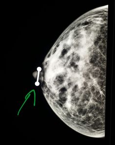 #Mammogram shows a #nipple #ring. #radiologist #radiology #breastcancer #cancer Science Biology, X Ray, Medicine