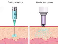 Hyaluronic Acid Lips, Hyaluronic Acid Fillers, Subcutaneous Tissue, Cosmetic Injectables, Injectables Fillers, Plump Lips, Facial Aesthetics, Botox Fillers, Facial Plastic