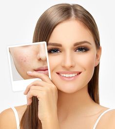 Say goodbye to acne and hello to clear skin. StyleCraze features the most effective acne and pimple care treatments, remedies, and tips for blemish-free skin. Best Foundation For Acne, Severe Acne Remedies, Masks For Acne, Cystic Acne Remedies, Pimples Under The Skin, Remedies For Acne, Diy Acne, Acne Face Wash, Natural Acne Remedies