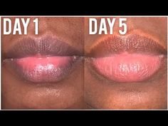 Remedies For Dark Lips, Soft Pink Lipstick, Getting Pregnant Tips, Lip Lightening, Natural Skin Lightening, Lip Tips, Beauty Hacks Lips, Pimples On Face, Dry Skin Remedies