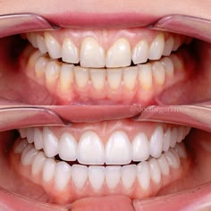 Teeth Before And After, Teeth Whitening Before And After, Perfect Teeth Aesthetic, Veneers Before And After, Veneer Teeth, Teeth Makeover, Teeth Veneers, Teeth Aesthetic