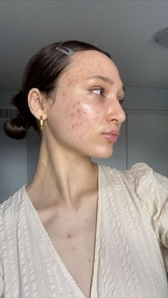 Acne prone & glowy skin Acne Photos, Girl With Acne, Skincare Science, Face Mapping Acne, Acne Treatments, Skin Hyperpigmentation, Natural Acne Remedies, Healthy Skin Tips, Face Acne