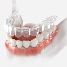 Give teens the confidence to pursue their passion with a boost from a brand-new Invisalign® smile. #SecureDental #SecureDentalIL #DrNazishJafri #DrNoelLiu #Smile #OralHealth #Dentist Dental Orthodontics, Aligners For Teeth, Implant Dental, Smile Design Dental, Dental Endodontic, Affordable Dentures, Dental Retainer, Dental Pictures, Teeth Whitening Procedure