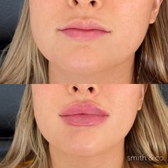 Allergan Botox, Fuller Lips Naturally, Aesthetic Medical, Face Treatments, Facial Fillers