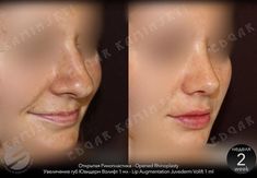 Rhinoplasty Before And After, Job Inspiration