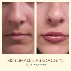 Lips Reference, Aesthetic Dermatology, Small Lips, Desired Body, Esthetician Room, Body Features