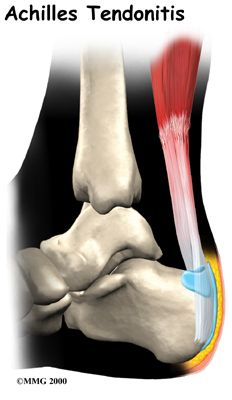 Physiotherapy in Regina, Physiotherapy for Achilles Tendon Problems Message Therapy, Signs Of Inflammation, Physical Therapy Assistant, Calf Muscles