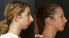 Chin Reduction, Lipo Before And After, Forehead Reduction, Chin Implant, Facial Procedure, Rhinoplasty Surgery, Reduction Surgery, Facial Anatomy, Big Nose Beauty