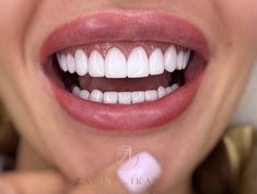 Straight Teeth, Smile Design