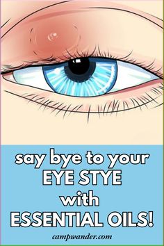 Home treatment is all that is needed for most styes! Learn how to treat an eye stye with natural home remedies here. This essential oil remedy for eye styes is effective and fast! Eye Relief Remedies, Natural Remedies For Stye Eye, Natural Stye Remedies, How To Treat A Stye In Your Eye, Home Remedy For Stye Eye, Eye Stye Remedies How To Get Rid, How To Get Rid Of Stye Eye Overnight, How To Treat A Stye Eye, How To Get Rid Of A Stye In Your Eye