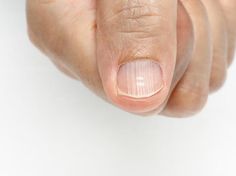 Horizontal Nail Ridges, Fingernail Ridges, Fingernail Health, Nail Ridges, Nail Problems, Easy Nails, Nail Pictures, Nail Bed, Brittle Nails