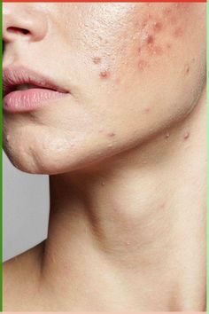 Explore cutting-edge acne treatments recommended by top dermatologists to finally achieve clear and radiant skin. Acne Aesthetic, Acne Photos, Skin Breakouts, Remove Skin Tags Naturally, Stubborn Acne, Acne Overnight, Acne Face, Acne Skincare Routine, Natural Acne Remedies