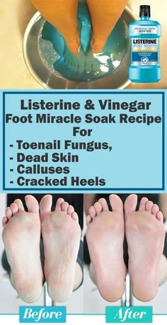 Listerine Foot Soak, Foot Soak Recipe, Toenail Fungus, Nail Fungus, Skin Care Remedies, Foot Care, Health And Beauty Tips, Beauty Treatments